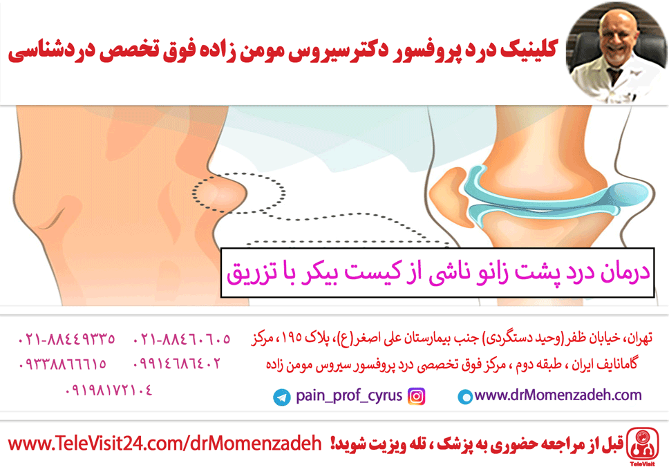 درمان درد پشت زانو ناشی از کیست بیکر (Baker’s cyst) با تزریق