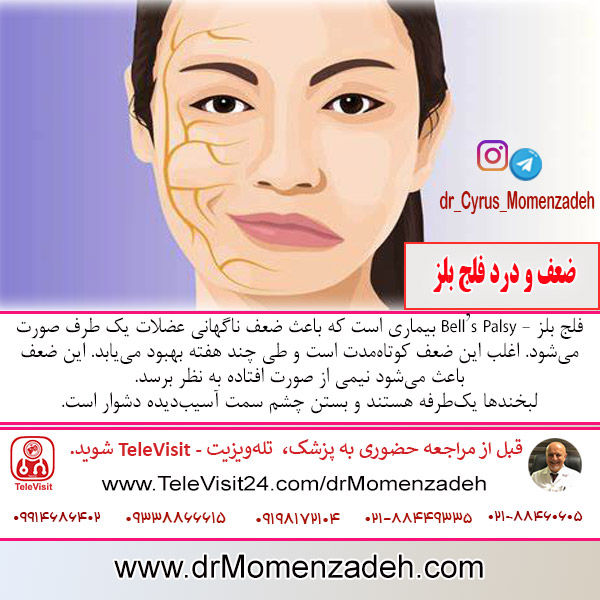 ضعف و درد فلج بلز