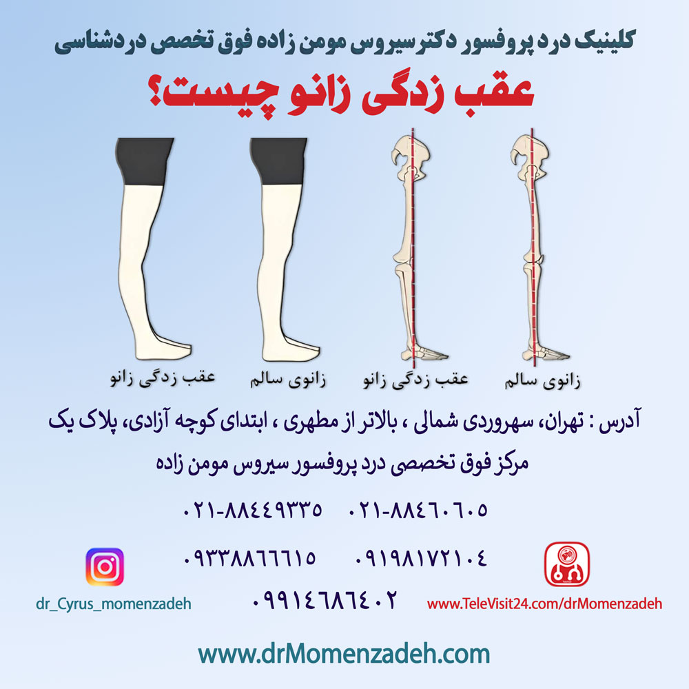 عقب‌ زدگی زانو چیست 
