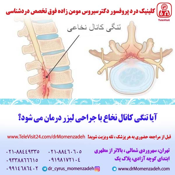 آیا تنگی کانال نخاع با جراحی لیزر درمان می شود؟