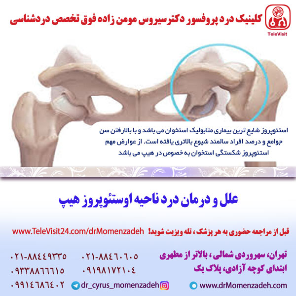 علل و درمان درد ناحیه اوستئوپروز هیپ