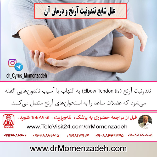علل شایع تندونیت آرنج و درمان آن