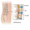 دیسک کمر : راه های درمان و علائم 