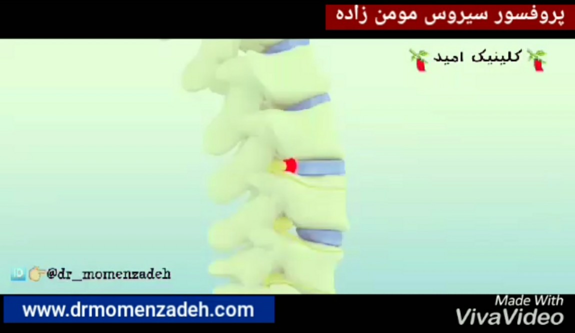 عمل دیسک کمر بدون نیاز به جراحی باز