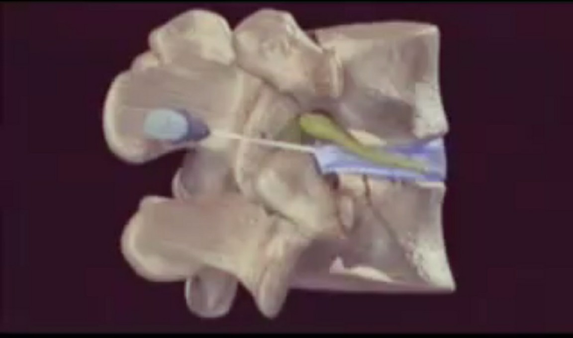 درمان دیسک کمر و گردن توسط عمل روز لیزر تراپی