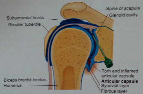 سندروم شانه یخ زده