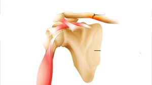 درد استخوان ترقوه، شانه و کتف 1