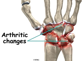 آرتریت مچ دست2