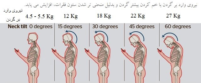 گردن درد اس ام اسی 2