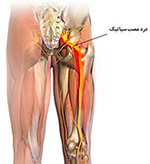 Sciatica1