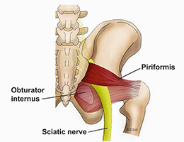 Sciatica2