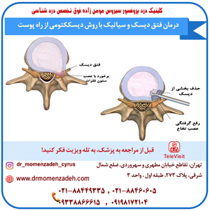 درمان فتق دیسک و سیاتیک