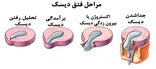 مراحل فتق دیسک