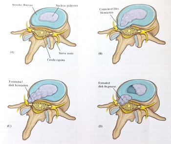 مراحل فتق دیسک