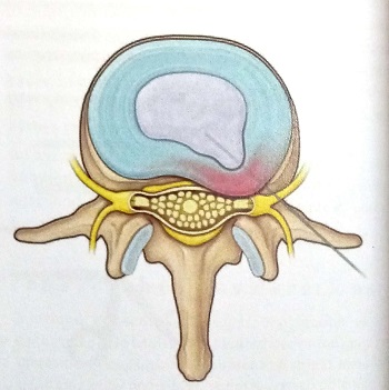 درمان فتق دیسک بدون جراحی