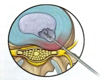 درمان فتق دیسک بدون جراحی