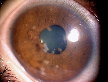 علائم چشمی درد سارکوئیدوز