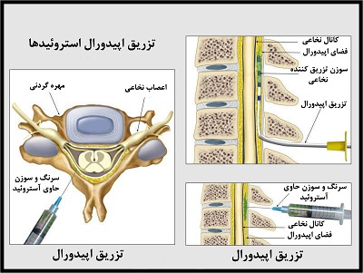 چسبندگی اپیدورال