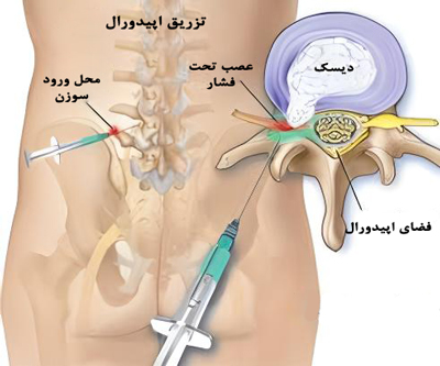 چسبندگی اپیدورال