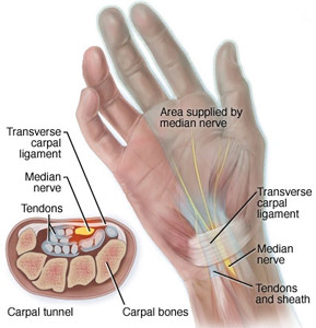 تحت فشار قرار گرفتن عصب مدین در تونل کارپال