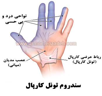 سندروم تونل کارپال