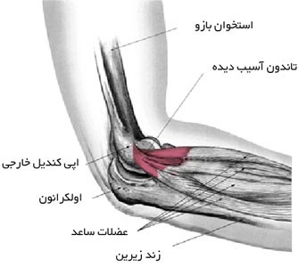 درمان آرنج تنیس باز