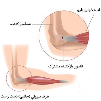 درمان آرنج تنیس باز