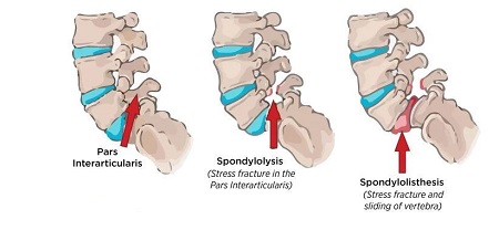 اسپوندیلوز و اسپوندیلولیستزیس