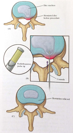 کاهش فشار دیسک با روش زیر جلدی با استفاده از نوکلئوپلاستی