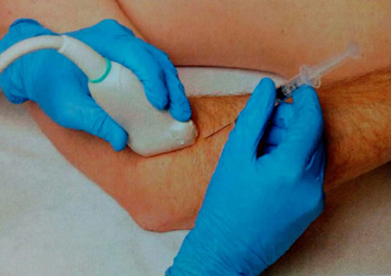 درمان درد اپی کوندیلیت خارجی با تزریق تاندون عضله کارپی رادیالیس برویس
