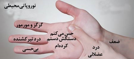 نوروپاتی محیطی