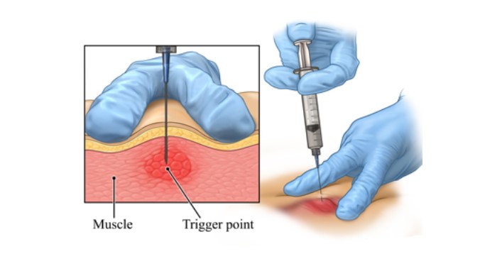 تزریق نقاط ماشه ای (Trigger point) گردنی