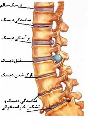 مراحل فتق دیسک