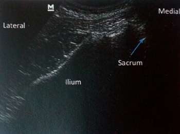 عضله پریفورمیس(Piriformis)