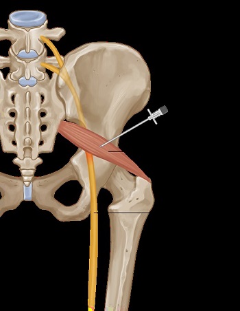 عضله پریفورمیس(Piriformis)