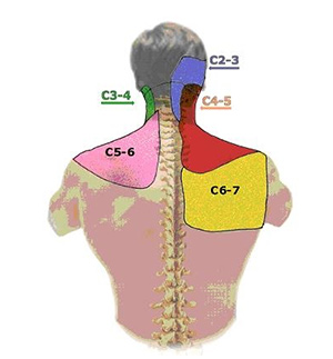محل احساس شدن درد بر حسب مفصل فست گردنی درگیر