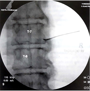 تصویر فلوروسکوپی سوزن در محل عصب