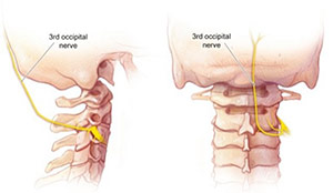 عصب اکسیپیتال گردن