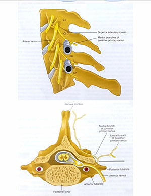 فلوروسکوپی سوزن در محل عصب شاخه داخلی گردن