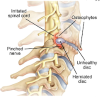 دیسک برون زده اعصاب نخاعی گردنی