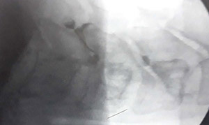 تصویر فلوروسکوپی سوزن در محل مفصل