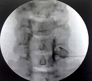 تصویر فلوروسکوپی سوزن در محل عصب