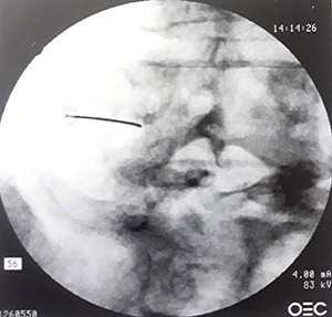 تصاویر فلوروسکوپی سوزن در محل یکی از اعصاب نخاعی