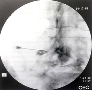 تصاویر فلوروسکوپی سوزن در محل یکی از اعصاب نخاعی
