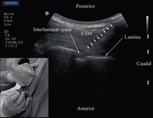 انجام بلاک و تصویر سونوگرافی سوزن در فضای اپیدورال