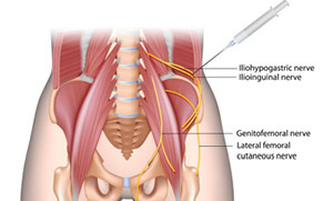 بلاک عصب ایلیوهایپوگاستریک