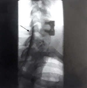 تصاویر فلوروسکوپی سوزن در فضای اپیدورال