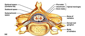 epidural