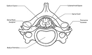 epidural