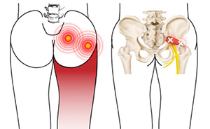 بلاک عصب سیاتیک در باسن